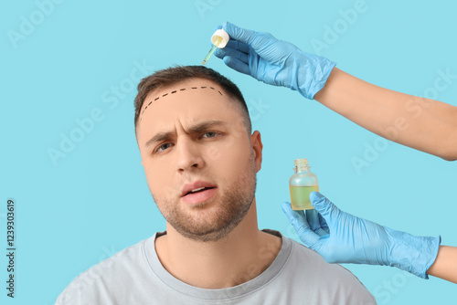 Young man with hair loss pr...