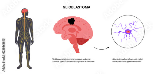 Glioblastoma brain cancer