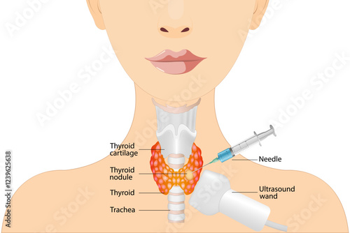 Fine needle aspiration biopsy of the thyroid gland in a patient using an ultrasound machine. Thyroid biopsy