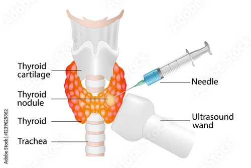 Fine needle aspiration biopsy of the thyroid gland