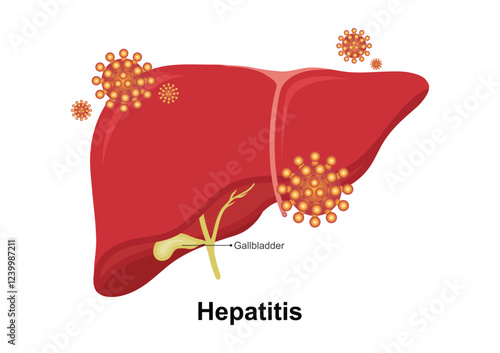 Hepatitis is an inflammation of the liver.