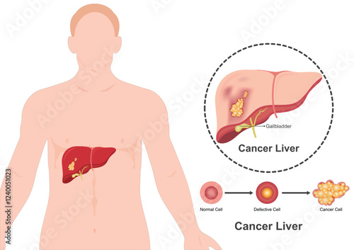 Liver cancer disease occurs when tumor cells develop from cells.