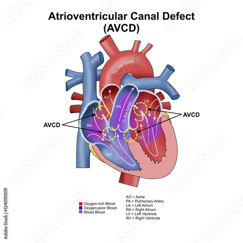 Atrioventricular Canal Defect (AVCD) Illustration