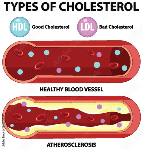 Understanding Cholesterol and Blood Vessels