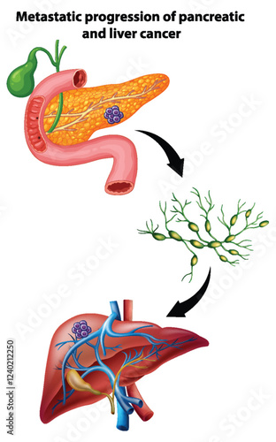 Metastatic Progression of Pancreatic Cancer