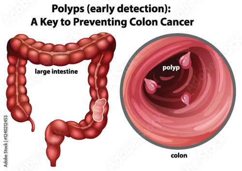 Early Detection of Colon Polyps