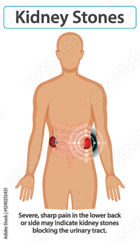 Understanding Kidney Stones and Symptoms