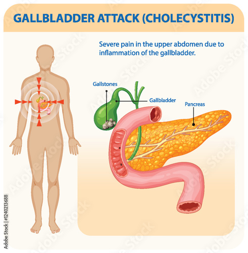 Understanding Gallbladder Attack and Cholecystitis