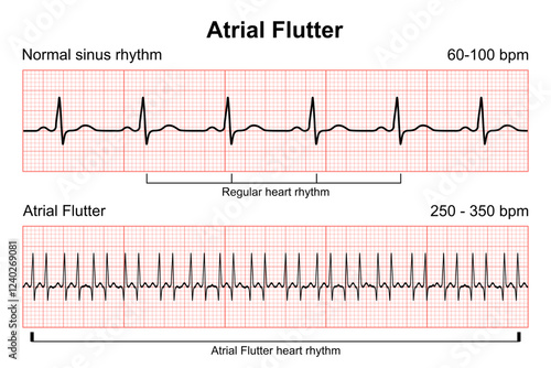 Atrial Flutter heart rhythm illustration