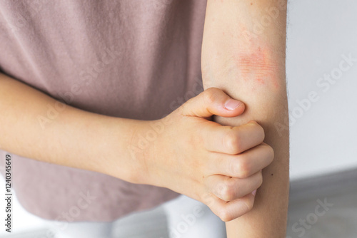 A child scratching an irritated red rash on their arm, showing symptoms of atopic dermatitis. The close-up highlights the discomfort and dry, inflamed skin, concept of health, allergies, skin diseases