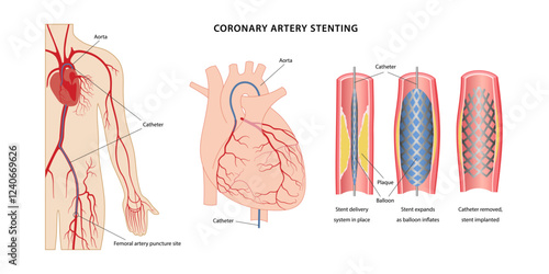 Coronary artery stenting. Scheme of coronary artery stenting using femoral artery puncture. Medical illustration of stages of stenting. Vector illustration in flat style isolated on white background.