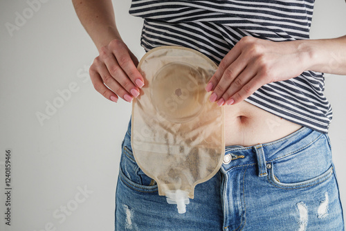young girl holding a colonostomy near her stomach, bowel cancer concept