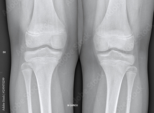 Obraz na plátně X-ray image reveals Osgood-Schlatter disease affecting knees