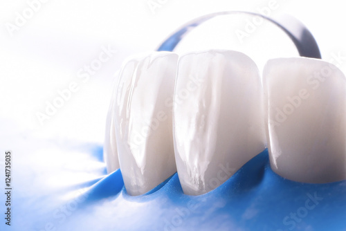 veneers fixation with rubber dam