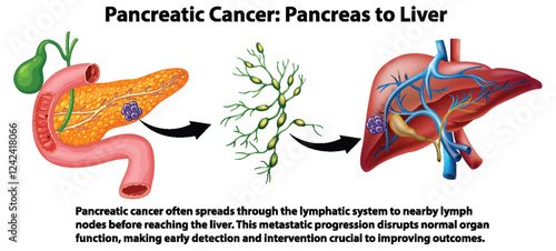 Pancreatic Cancer Metastasis to Liver