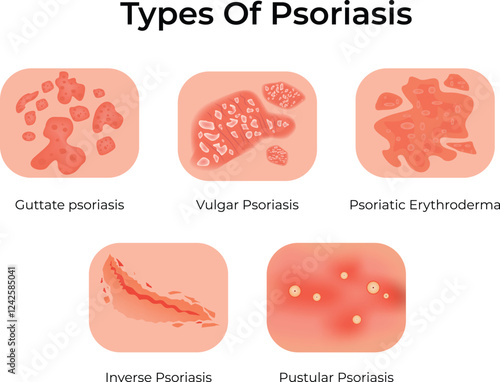 Types of Psoriasis Design Vector Illustration