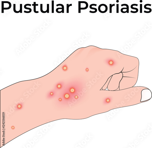 Pustular Psoriasis on Hand Design Vector Illustration