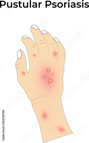 Pustular Psoriasis on Hand Design Vector Illustration