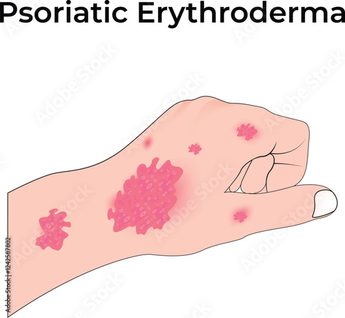 Psoriatic Erythroderma Design Vector Illustration