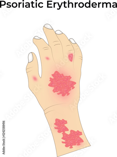 Psoriatic Erythroderma Design Vector Illustration