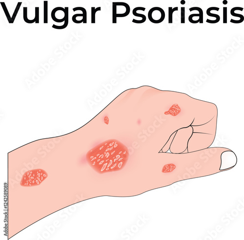 Vulgar Psoriasis on Hand Design Vector Illustration