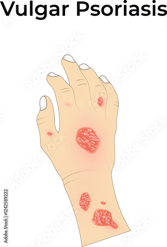 Vulgar Psoriasis on Hand Design Vector Illustration