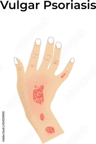 Vulgar Psoriasis on Hand Design Vector Illustration