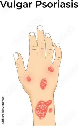 Vulgar Psoriasis on Hand Design Vector Illustration