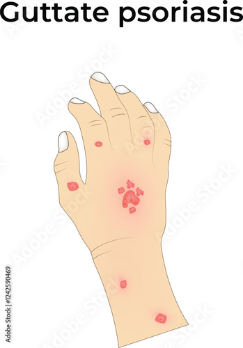 Guttate Psoriasis on Hand Design Vector Illustration