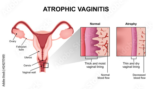 Vaginal atrophy (genitourinary syndrome of menopause or atrophic vaginitis) 