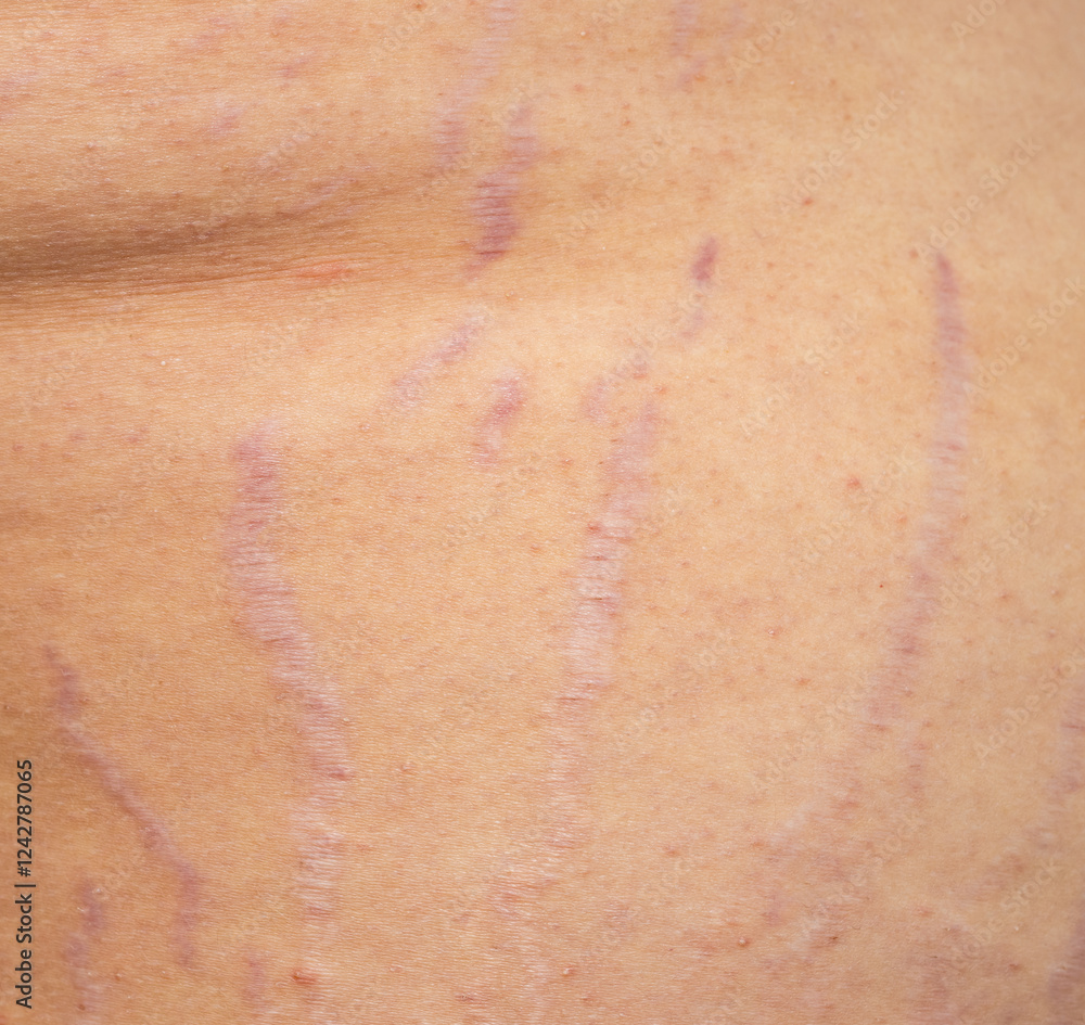 Fototapeta premium A person's skin is covered in red marks