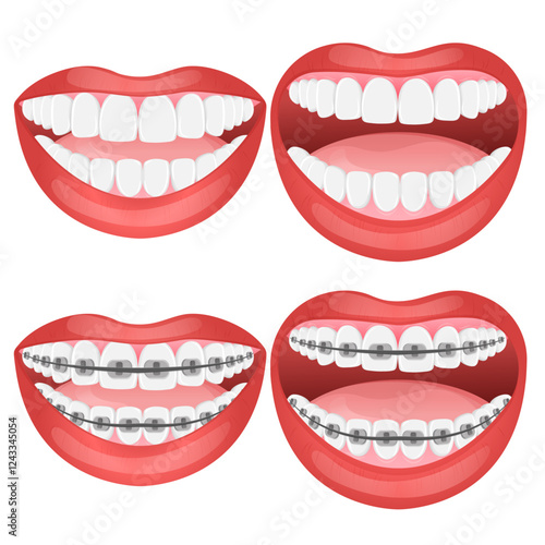 Vector image of mouth and teeth. Braces and bite correction. Dentistry and dental treatment concept. Element for your design of banners, posters, articles, etc.