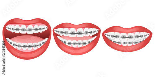 Vector image of mouth and teeth. Braces and bite correction. Dentistry and dental treatment concept. Element for your design of banners, posters, articles, etc.