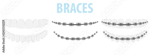 Vector image of mouth and teeth. Braces and bite correction. Dentistry and dental treatment concept. Element for your design of banners, posters, articles, etc.