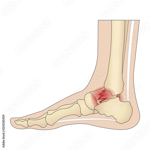 Anatomical structure of the human foot with a painful part