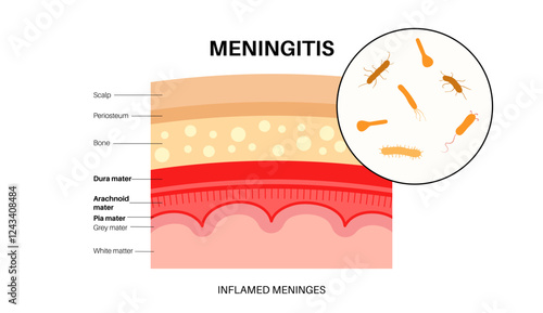 Meningitis medical poster