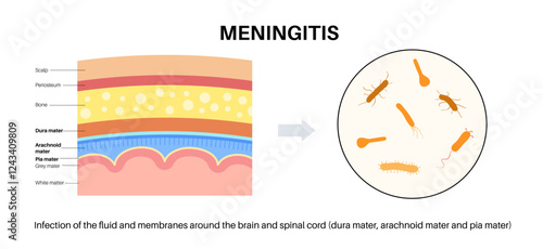 Meningitis medical poster