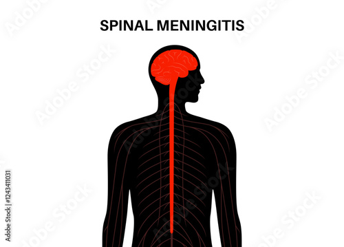 Spinal meningitis poster