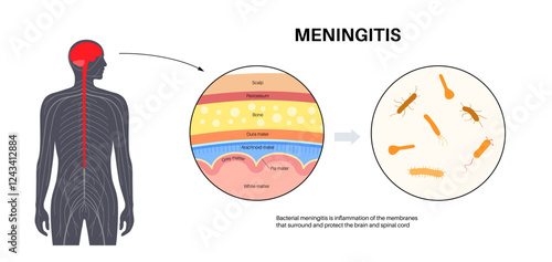 Meningitis medical poster