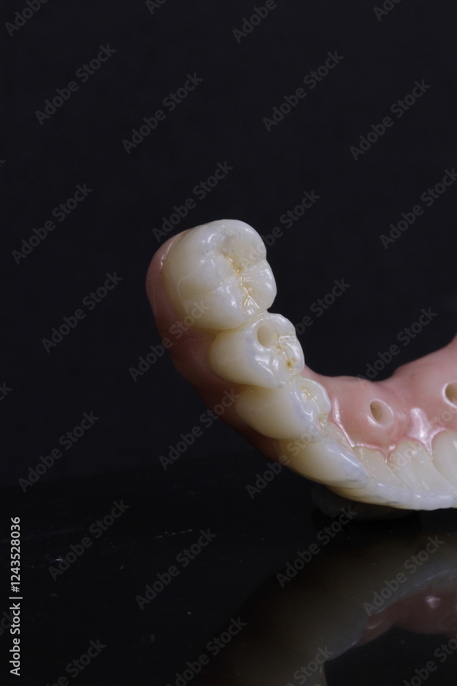 Obraz premium dental prosthesis veneers implant
