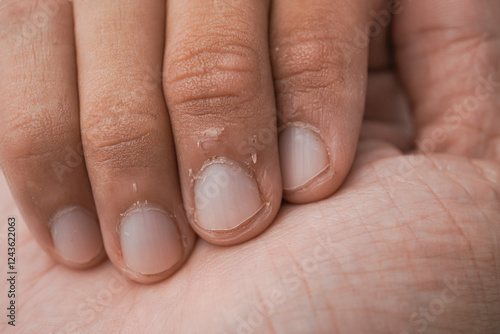 Tableau sur toile Dry and peeling skin under the fingernails, which may be caused by dry skin, dehydration, and a deficiency of nutritional vitamins or minerals