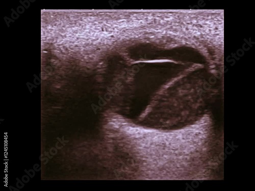 retinal detachment, and vitreus hemorrhage , ocular ultrasonography photo