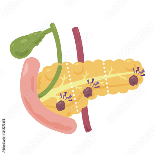 膵臓がんになった膵臓のイラスト2