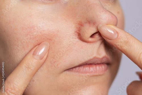 Photos Close-up young Caucasian woman showing redness and inflamed blood vessels on her nose