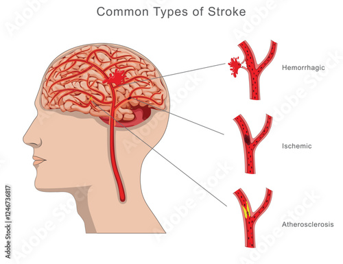 Illustration of common types of brain stroke, including ischemic, hemorrhagic, and transient ischemic attack, highlighting causes, effects, and impact on brain function