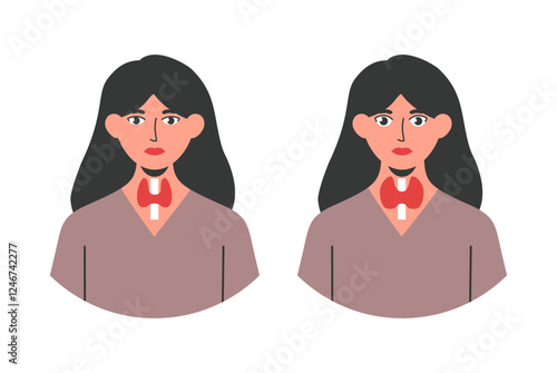 Graves disease illustration showing a woman with bulging eyes and enlarged thyroid compared to normal. Represents hyperthyroidism, hormonal imbalance, and autoimmune disorder. Vector illustration.