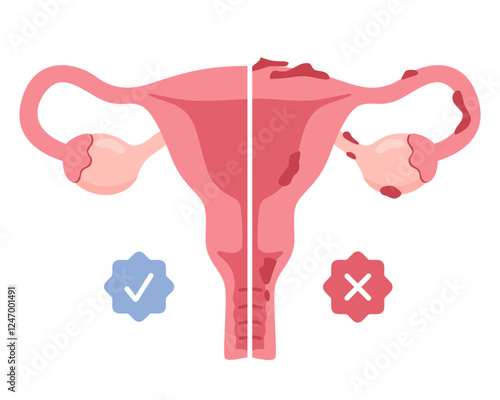 Uterus with endometriosis infographic in flat style.