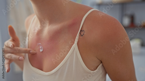 Fotografie Woman applying lotion on sunburned skin at a wellness spa in a serene room with