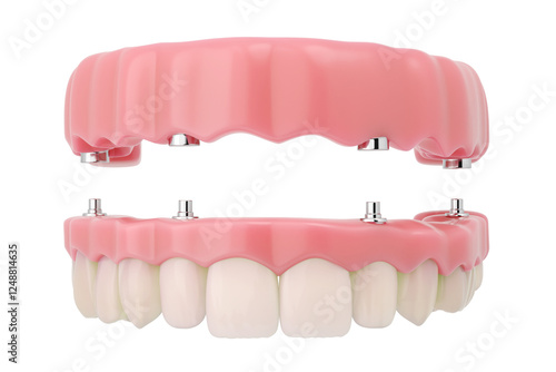full mouth dental implant with screw-supported denture, Front view.