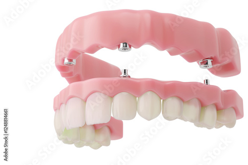 full dental implant showing fixed gum-supported prosthesis. 3D illustration